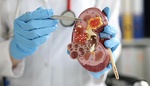 Preventivní prohlídky nově odhalí nemocné ledviny. Jejich selhání probíhá dlouhou dobu bez příznaků