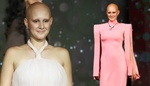 Čtrnáctiletá modelka s alopecií: Vlasy mi začaly vypadávat už ve třech letech, říká Klára Cheikhová