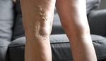 Křečové žíly trápí ženy i muže. Prevencí je žilní gymnastika